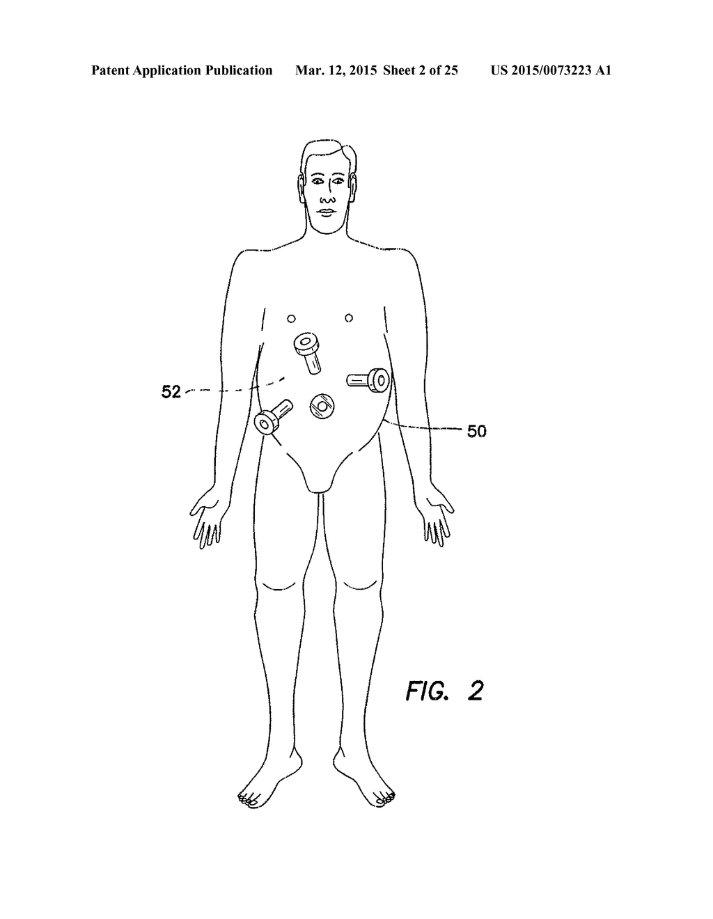 TROCAR CANNULA ASSEMBLY AND METHOD OF MANUFACTURE - diagram, schematic, and image 03