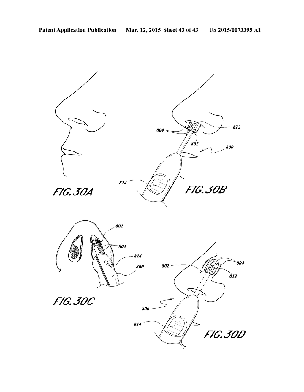 METHODS AND DEVICES TO TREAT NASAL AIRWAYS - diagram, schematic, and image 44