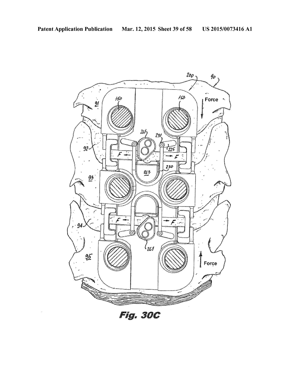 BONE PLATE ASSEMBLY WITH PLATES THAT RATCHET TOGETHER - diagram, schematic, and image 40