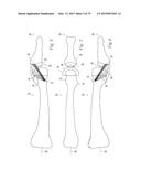 SOFT TISSUE REPAIR diagram and image