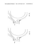 SUTURE PASSER AND METHOD FOR HIP LABRUM REPAIR diagram and image