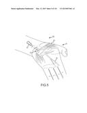 SYSTEMS AND METHODS FOR TREATMENT OF COMPRESSED NERVES diagram and image