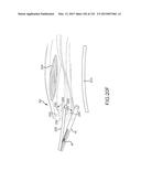 SYSTEMS AND METHODS FOR TREATMENT OF COMPRESSED NERVES diagram and image