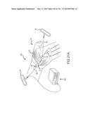 SYSTEMS AND METHODS FOR TREATMENT OF COMPRESSED NERVES diagram and image