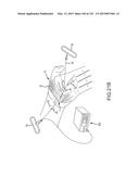 SYSTEMS AND METHODS FOR TREATMENT OF COMPRESSED NERVES diagram and image