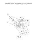 SYSTEMS AND METHODS FOR TREATMENT OF COMPRESSED NERVES diagram and image