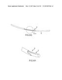 SYSTEMS AND METHODS FOR TREATMENT OF COMPRESSED NERVES diagram and image