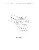 SYSTEMS AND METHODS FOR TREATMENT OF COMPRESSED NERVES diagram and image