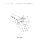 SYSTEMS AND METHODS FOR TREATMENT OF COMPRESSED NERVES diagram and image