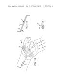 SYSTEMS AND METHODS FOR TREATMENT OF COMPRESSED NERVES diagram and image