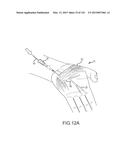 SYSTEMS AND METHODS FOR TREATMENT OF COMPRESSED NERVES diagram and image