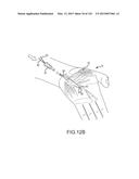 SYSTEMS AND METHODS FOR TREATMENT OF COMPRESSED NERVES diagram and image