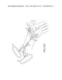 SYSTEMS AND METHODS FOR TREATMENT OF COMPRESSED NERVES diagram and image