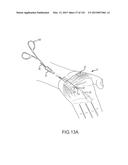 SYSTEMS AND METHODS FOR TREATMENT OF COMPRESSED NERVES diagram and image