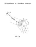 SYSTEMS AND METHODS FOR TREATMENT OF COMPRESSED NERVES diagram and image