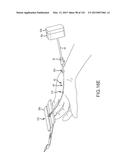 SYSTEMS AND METHODS FOR TREATMENT OF COMPRESSED NERVES diagram and image