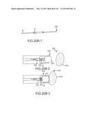 SYSTEMS AND METHODS FOR TREATMENT OF COMPRESSED NERVES diagram and image