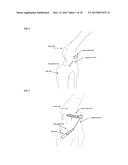 Joint stability device and method diagram and image