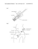 Joint stability device and method diagram and image