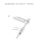 Joint stability device and method diagram and image