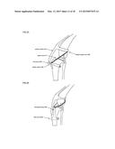 Joint stability device and method diagram and image