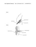 Joint stability device and method diagram and image