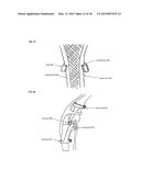 Joint stability device and method diagram and image