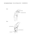 Joint stability device and method diagram and image