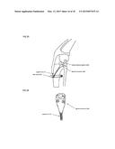 Joint stability device and method diagram and image