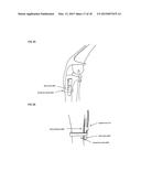 Joint stability device and method diagram and image