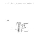 Joint stability device and method diagram and image