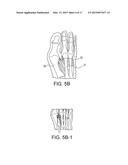 BUNION REPAIR USING SUTURE-BUTTON CONSTRUCT diagram and image