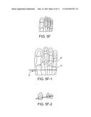 BUNION REPAIR USING SUTURE-BUTTON CONSTRUCT diagram and image