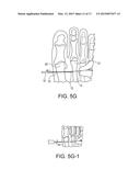 BUNION REPAIR USING SUTURE-BUTTON CONSTRUCT diagram and image