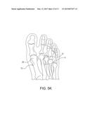 BUNION REPAIR USING SUTURE-BUTTON CONSTRUCT diagram and image