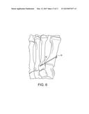 BUNION REPAIR USING SUTURE-BUTTON CONSTRUCT diagram and image