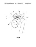 LINKED DEFLECTION DEVICES, SYSTEMS AND METHODS FOR THE PREVENTION OF     STROKE diagram and image