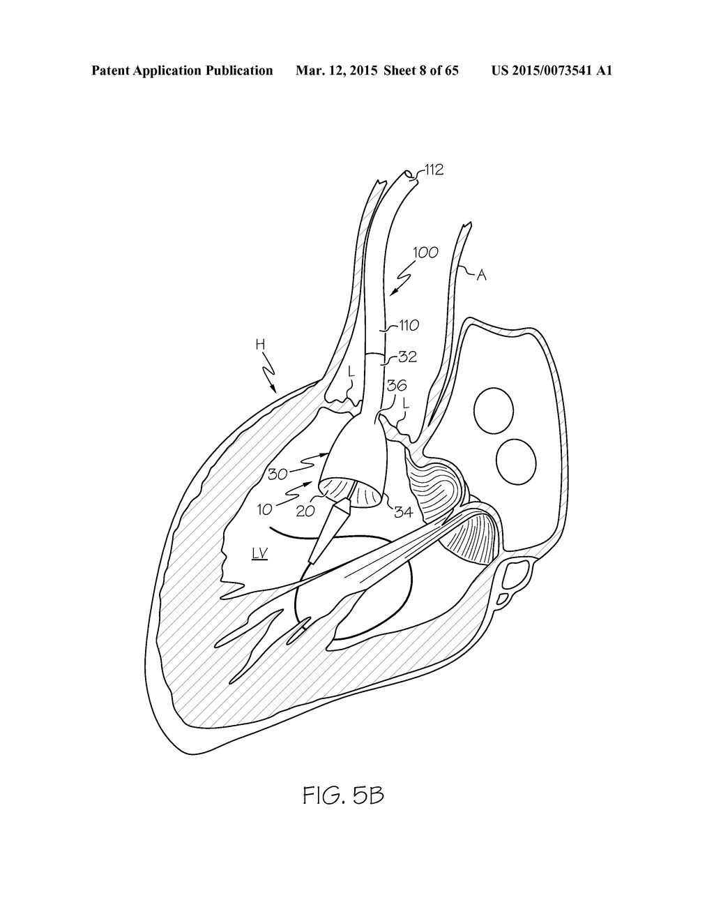 Repositionable Heart Valve and Method - diagram, schematic, and image 09