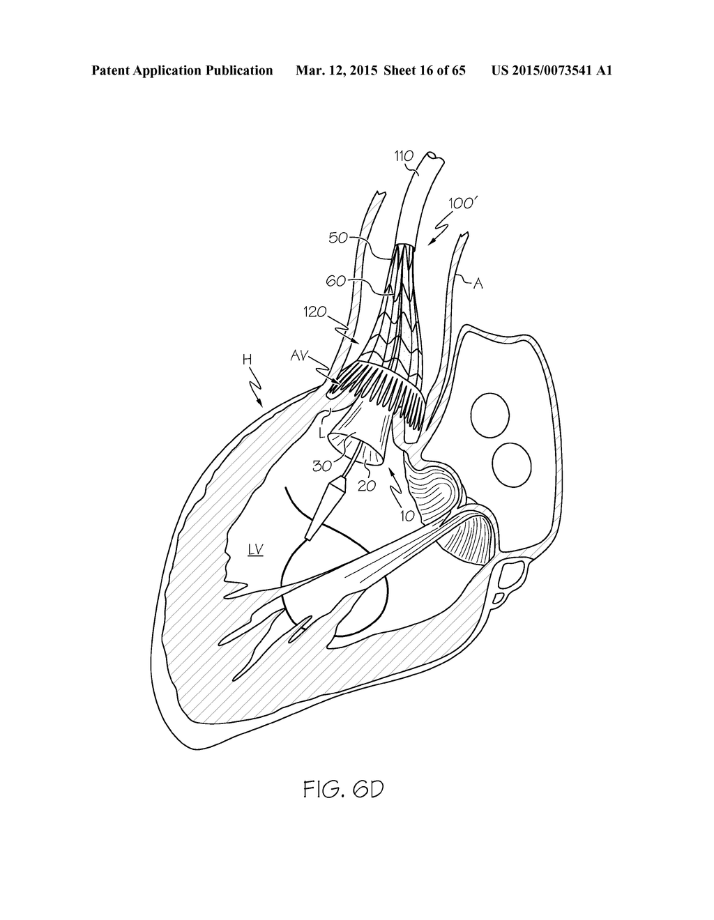 Repositionable Heart Valve and Method - diagram, schematic, and image 17