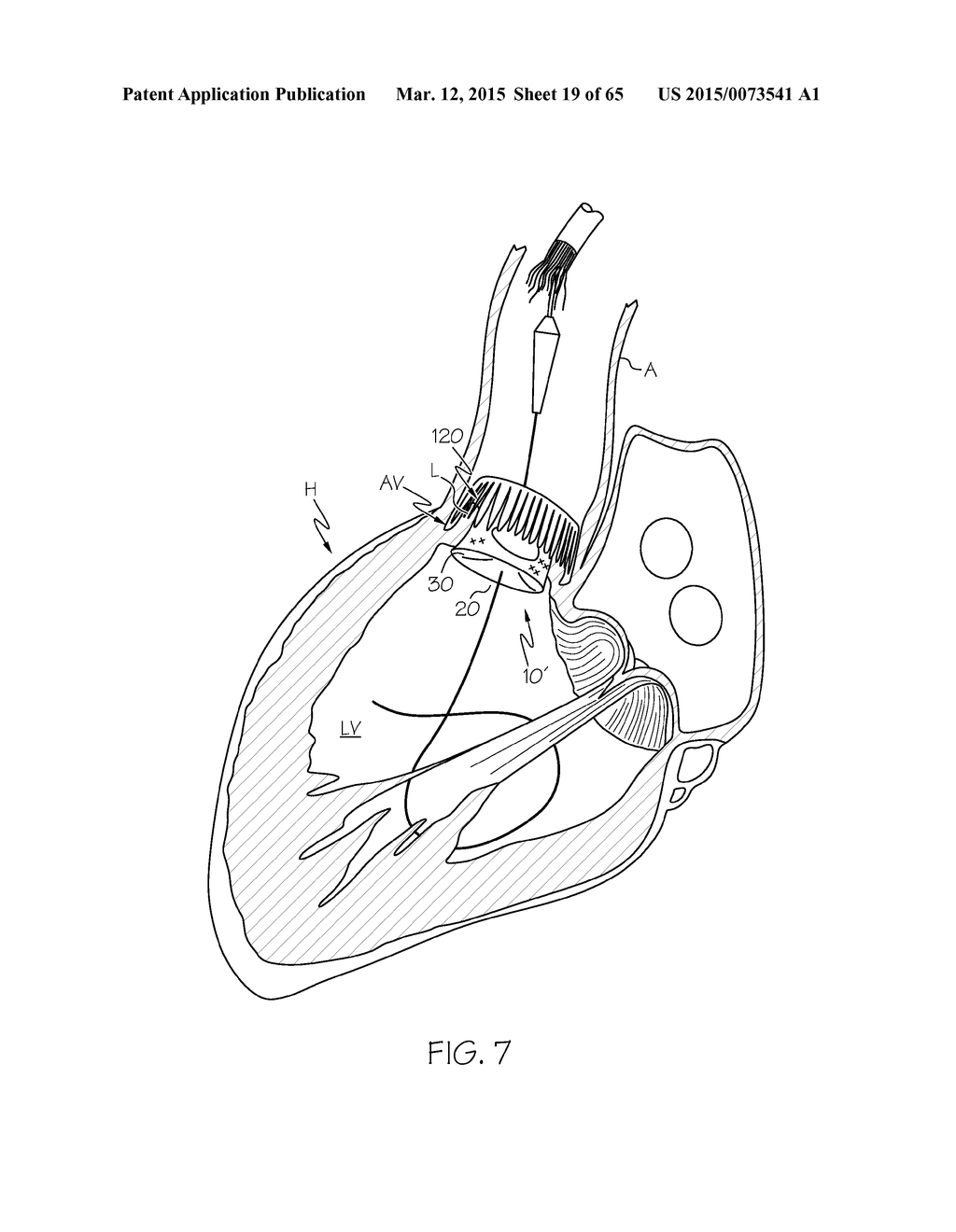 Repositionable Heart Valve and Method - diagram, schematic, and image 20