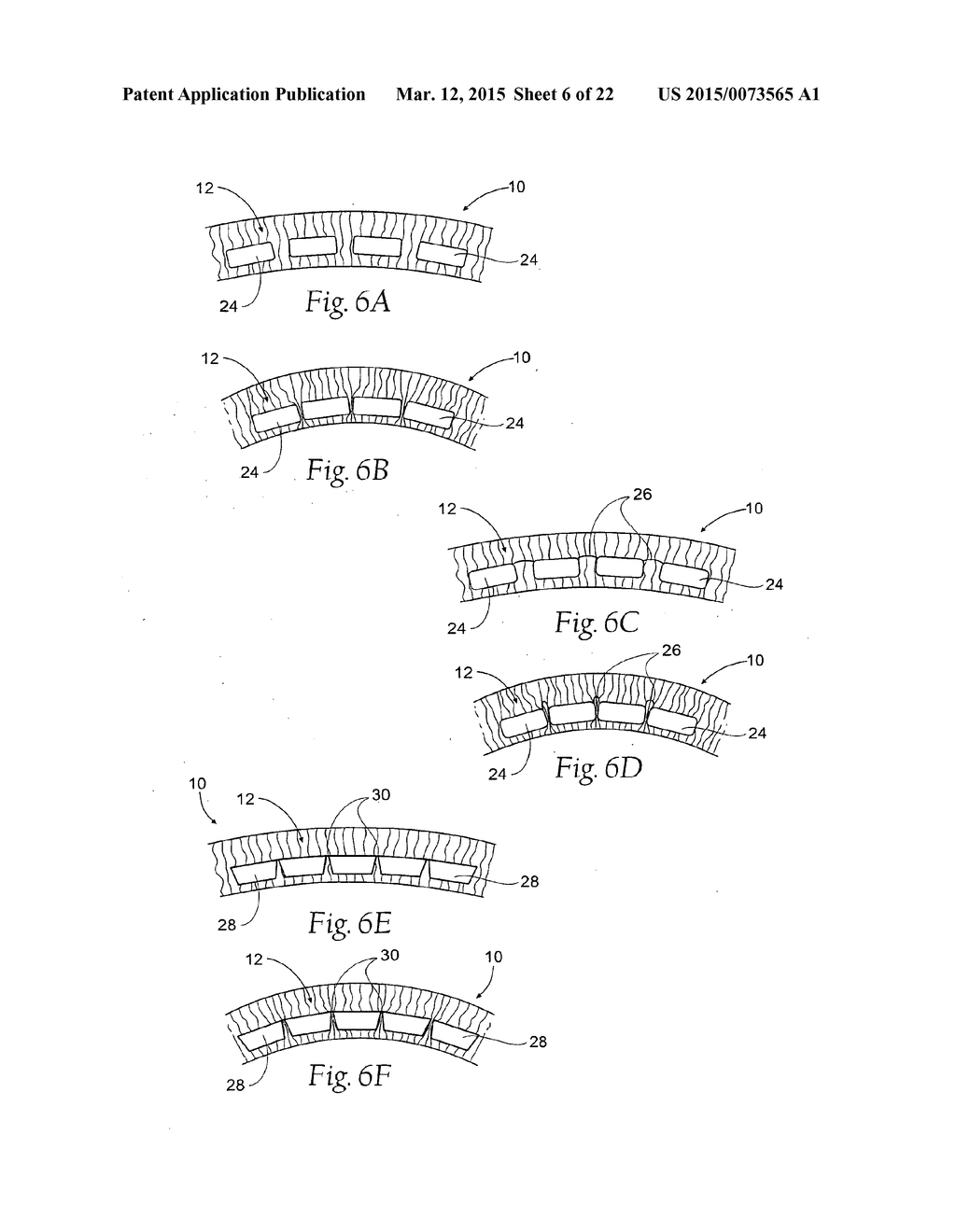 DEVICES, SYSTEMS, AND METHODS TO FIXATE TISSUE WITHIN THE REGIONS OF BODY,     SUCH AS THE PHARYNGEAL CONDUIT - diagram, schematic, and image 07