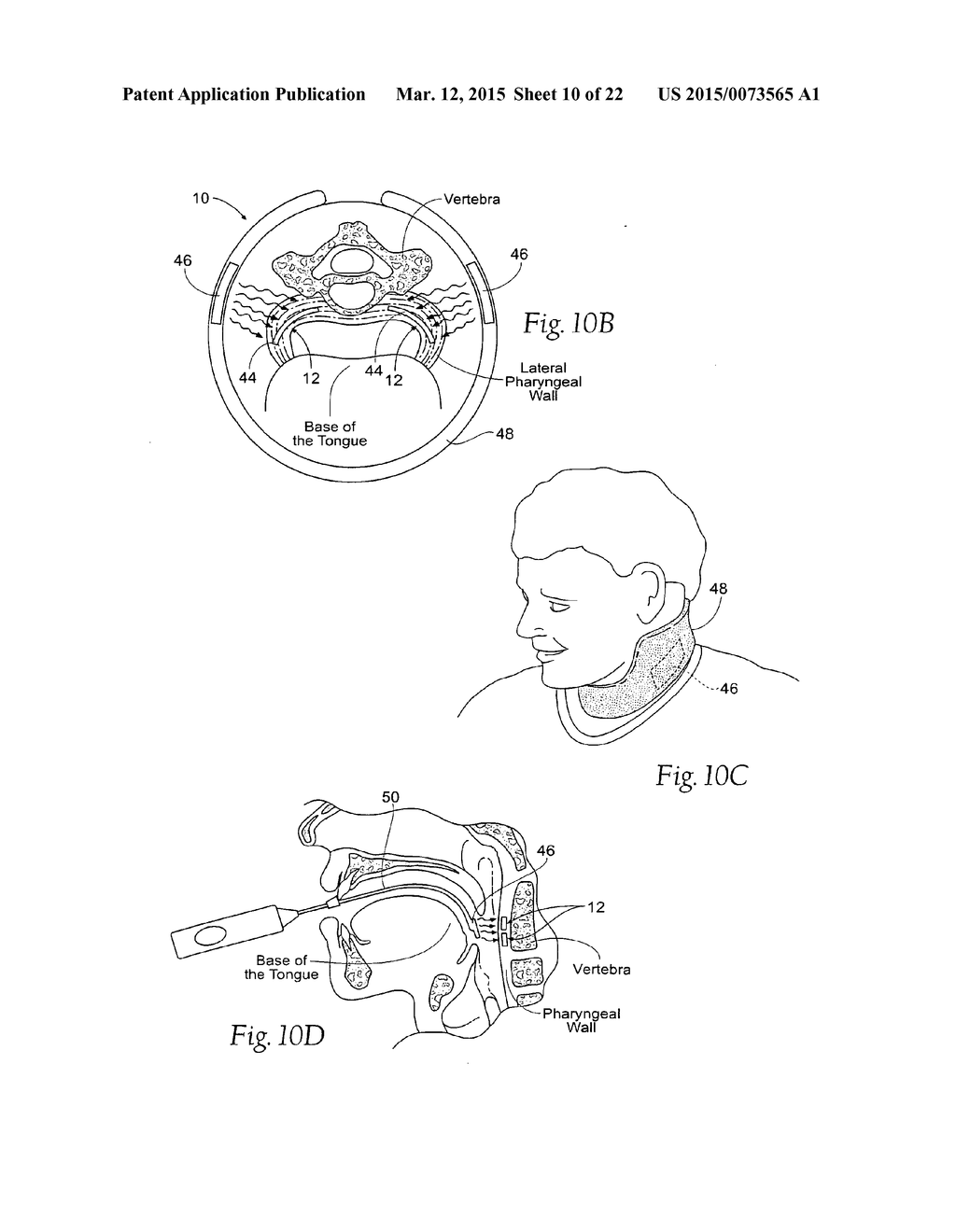 DEVICES, SYSTEMS, AND METHODS TO FIXATE TISSUE WITHIN THE REGIONS OF BODY,     SUCH AS THE PHARYNGEAL CONDUIT - diagram, schematic, and image 11