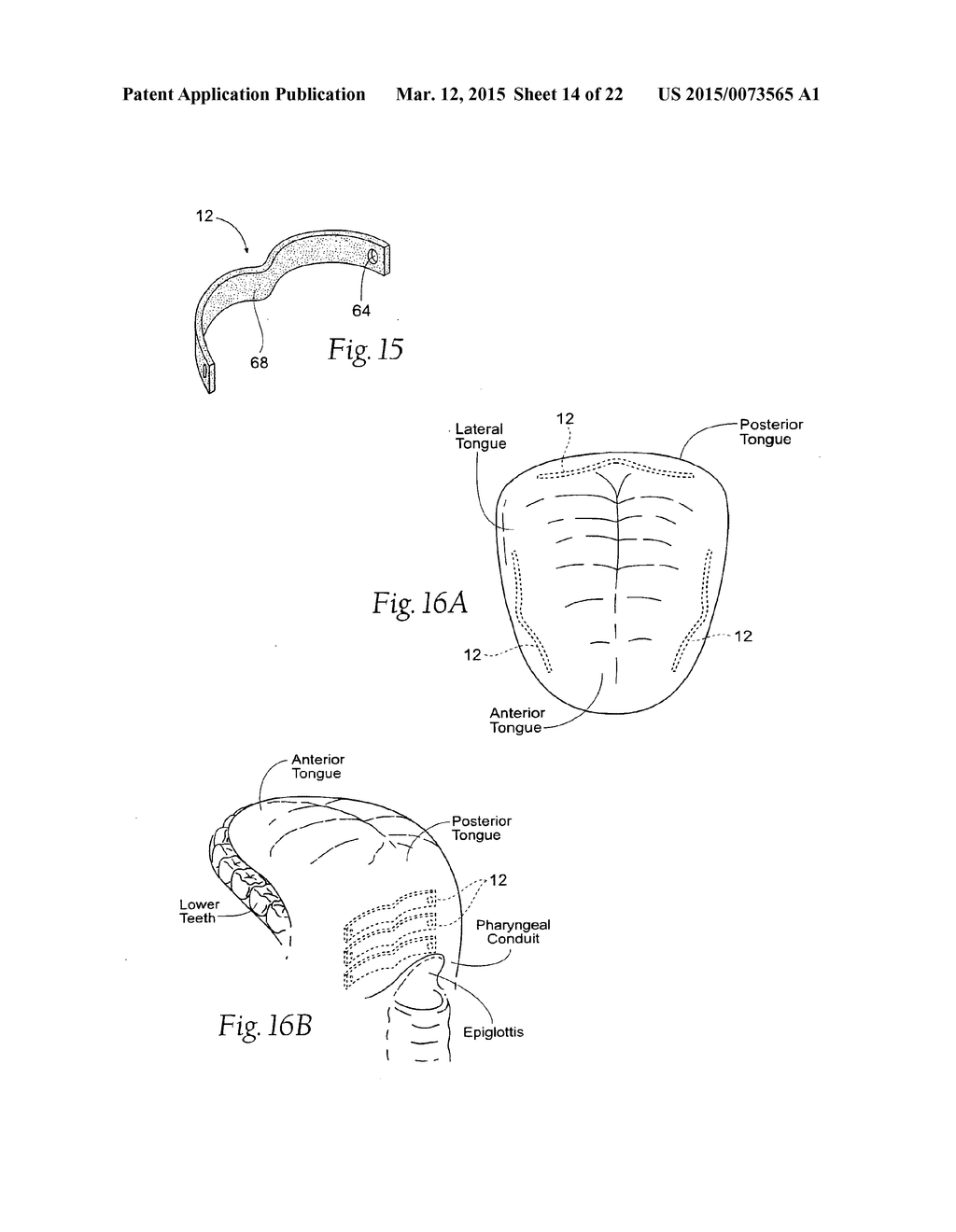 DEVICES, SYSTEMS, AND METHODS TO FIXATE TISSUE WITHIN THE REGIONS OF BODY,     SUCH AS THE PHARYNGEAL CONDUIT - diagram, schematic, and image 15