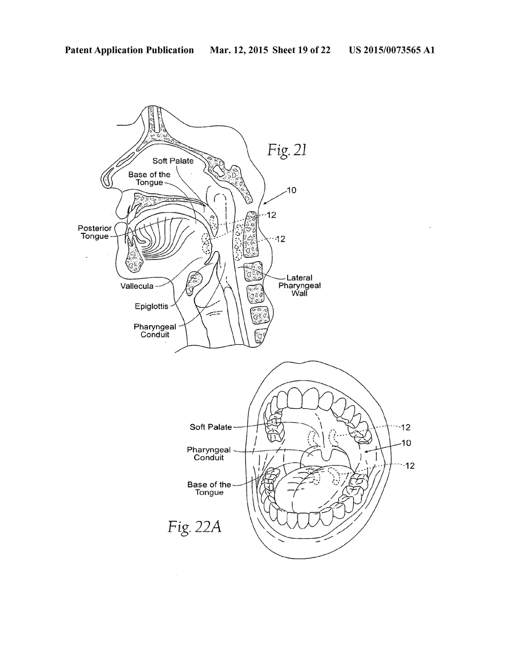 DEVICES, SYSTEMS, AND METHODS TO FIXATE TISSUE WITHIN THE REGIONS OF BODY,     SUCH AS THE PHARYNGEAL CONDUIT - diagram, schematic, and image 20