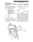 AIRWAY IMPLANTS AND METHODS AND DEVICES FOR INSERTION AND RETRIEVAL diagram and image