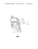 AIRWAY IMPLANTS AND METHODS AND DEVICES FOR INSERTION AND RETRIEVAL diagram and image