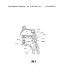 AIRWAY IMPLANTS AND METHODS AND DEVICES FOR INSERTION AND RETRIEVAL diagram and image