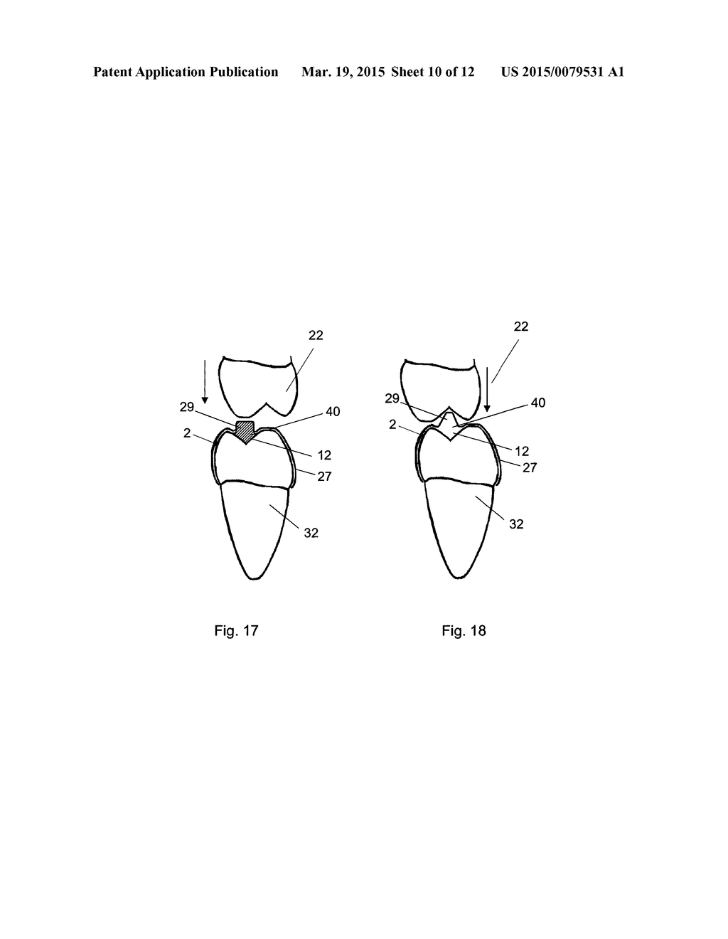 APPARATUS FOR TEMPOROMANDIBULAR JOINT-RELATED CORRECTIONS OF TOOTH     POSITION - diagram, schematic, and image 11