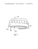 IMPLANT-BASED ATTACHMENT SYSTEM FOR DENTAL IMPLANT SURGICAL GUIDE AND     METHOD diagram and image