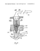 IMPLANT-BASED ATTACHMENT SYSTEM FOR DENTAL IMPLANT SURGICAL GUIDE AND     METHOD diagram and image